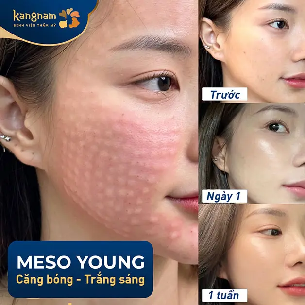 Làm sao để chọn nơi thực hiện tiêm Mesoestetic an toàn và hiệu quả?