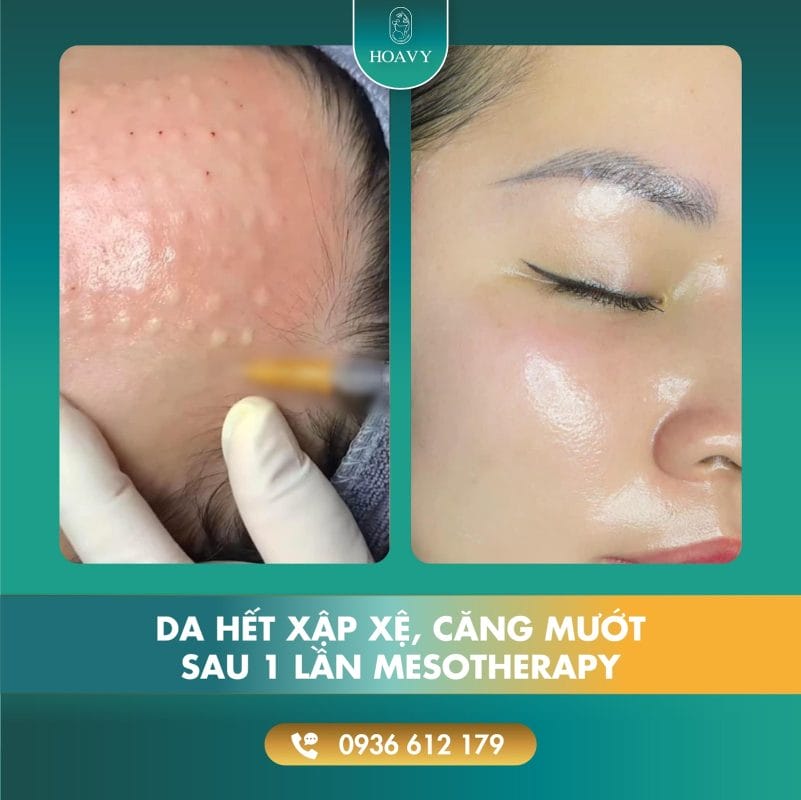 Ai nên tránh tiêm mesotherapy — những chống chỉ định thường gặp?