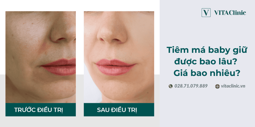 Tiêm má baby thường dùng chất gì — filler HA nào phù hợp và được khuyến nghị?