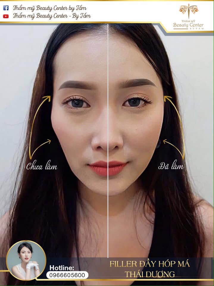 Quy trình tiêm má baby an toàn nên diễn ra như thế nào?