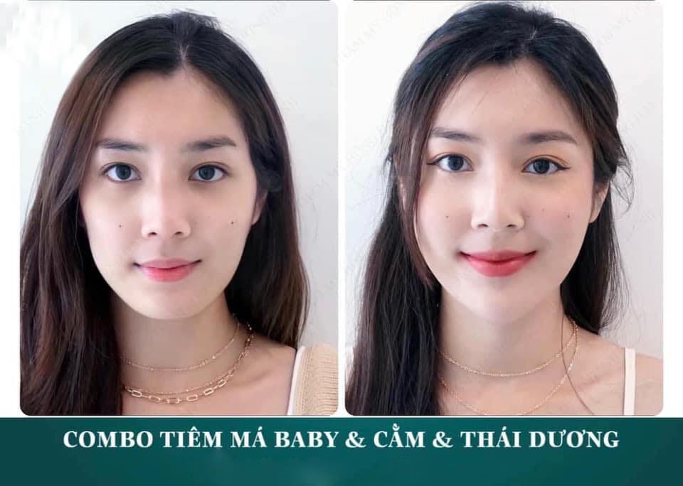 Những rủi ro thường gặp sau tiêm má baby và cách xử lý