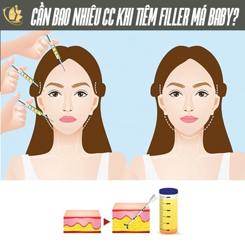 Chi phí thực tế ví dụ theo loại filler và số cc (kịch bản tham khảo)