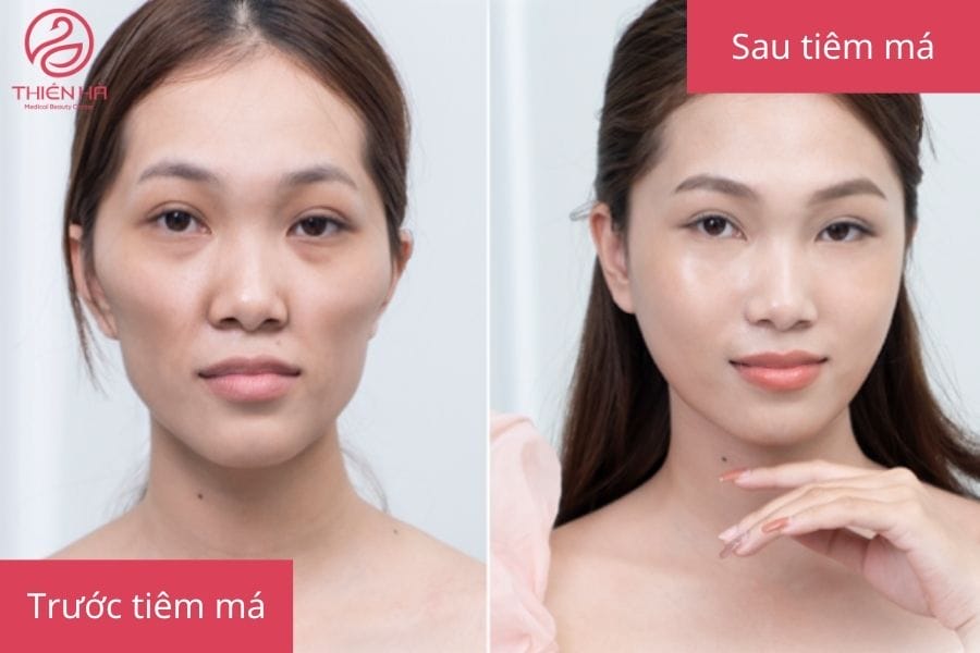 Quy trình tiêm má baby an toàn — khám, kỹ thuật và xử trí