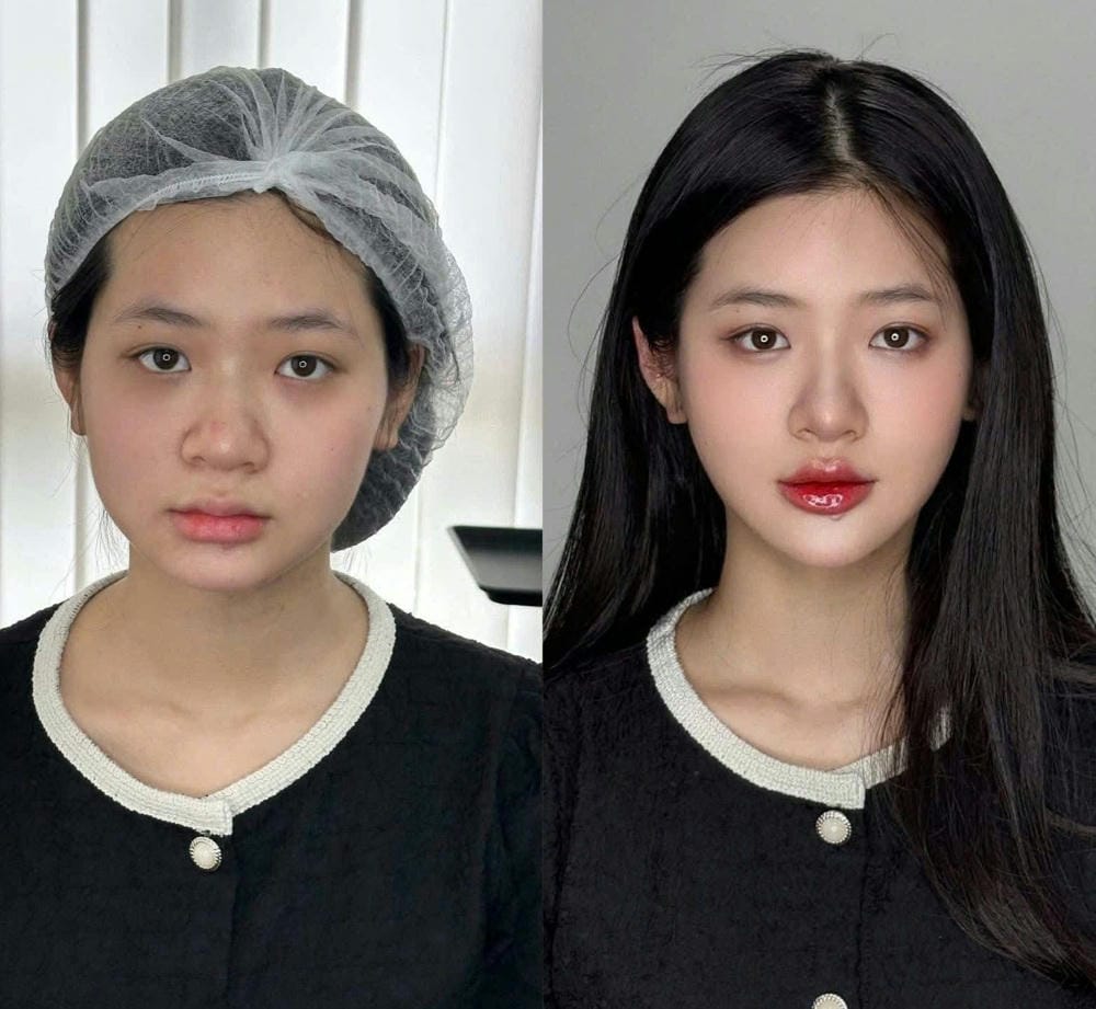 Juvederm so với các filler khác — chọn thế nào cho hiệu ứng má baby?