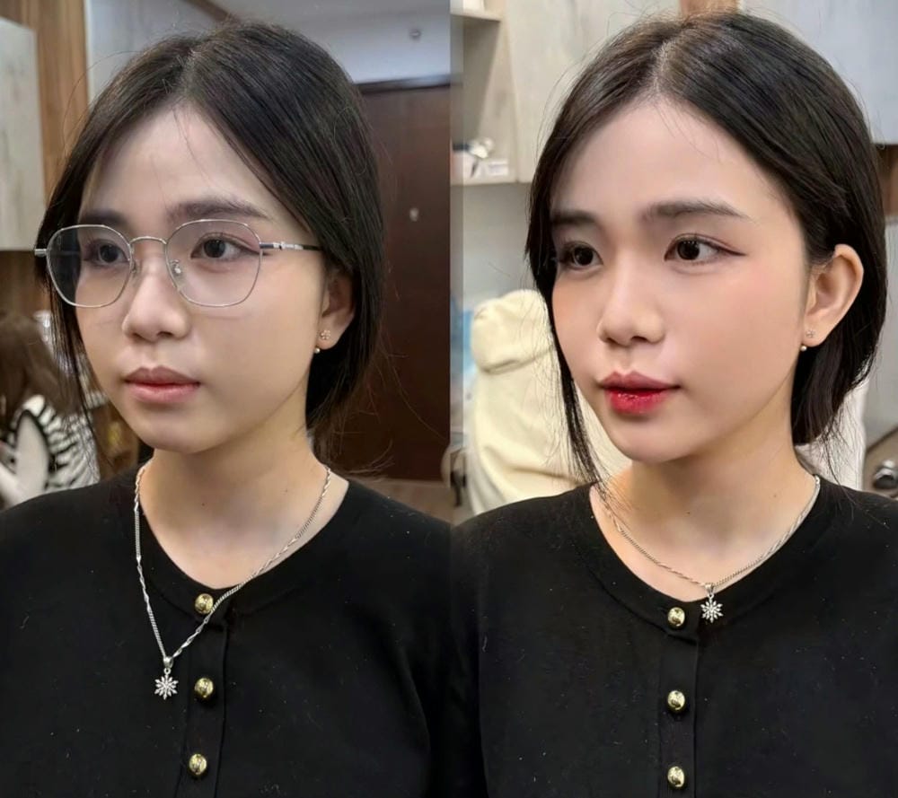 Tiêm má baby với Juvederm có an toàn và trông tự nhiên không?