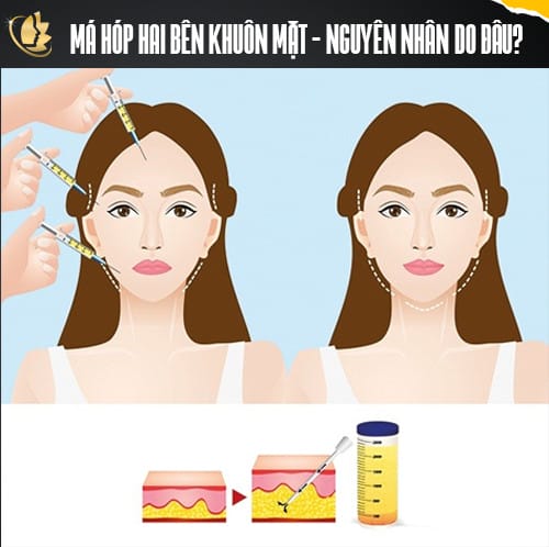 Những phương pháp hiện có để tạo má baby — phương án nào phù hợp với ai?