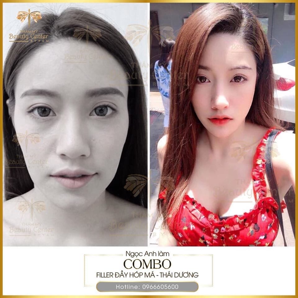 Bảng so sánh filler HA, chất kích thích collagen và cấy mỡ tự thân