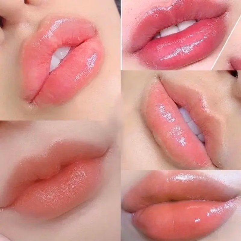 Chất kích thích sinh collagen (PLLA, PDLLA, CaHA...)