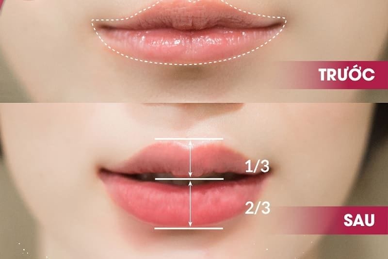 Chăm sóc sau tiêm môi: những việc nên làm và nên tránh để vào form nhanh, đẹp và an toàn?