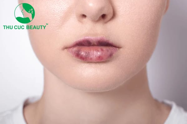 Làm thế nào để giảm nguy cơ bầm trước khi tiêm — checklist trước thủ thuật
