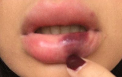 Chọn phòng khám và bác sĩ thế nào để giảm rủi ro bầm tím và biến chứng?