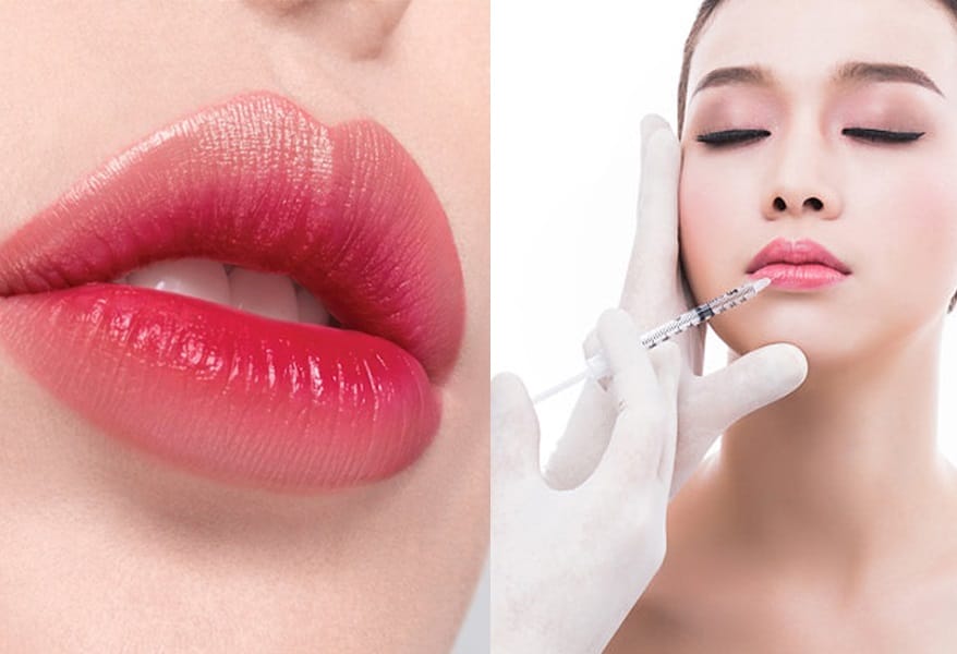 Cơ chế tác động của filler và hyaluronidase — tại sao tan được và có rủi ro?