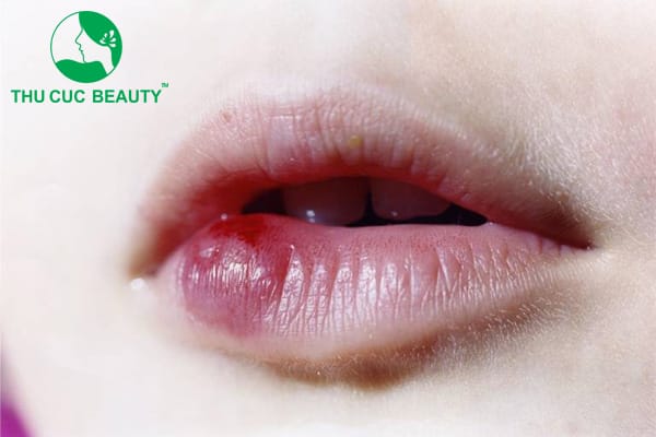 3. Gây tê cục bộ/niêm mạc hoặc block thần kinh