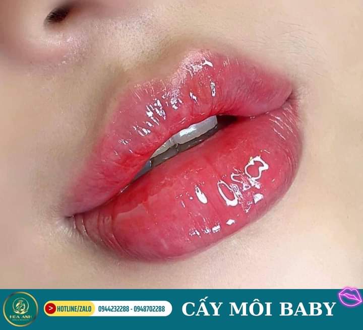 Bảng so sánh nhanh kỹ thuật tiêm môi an toàn