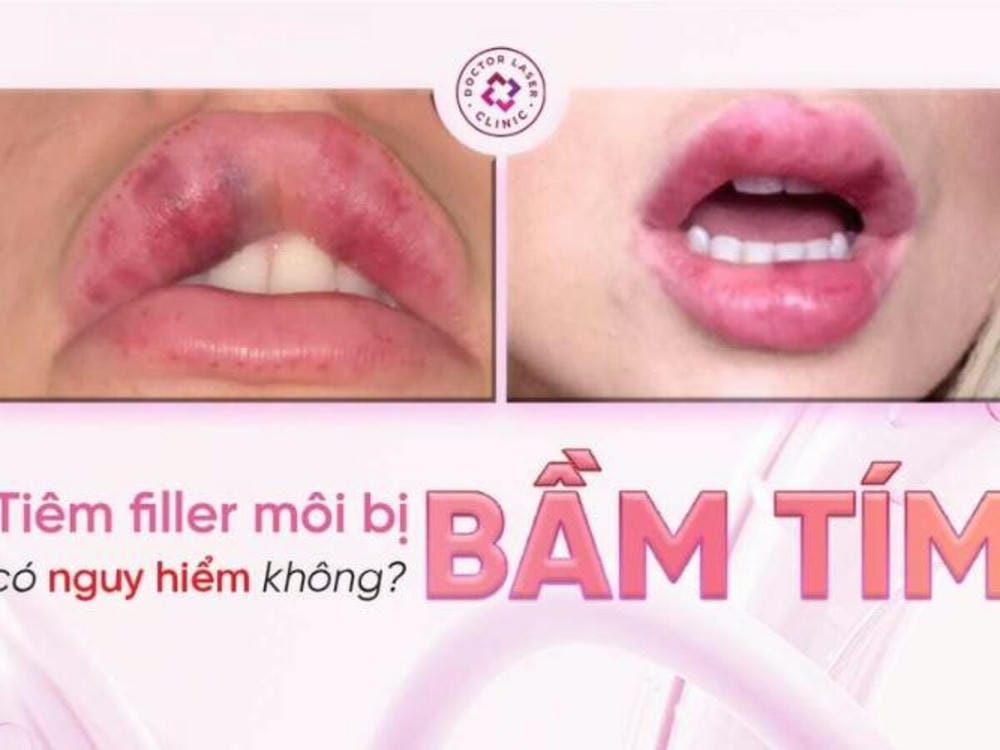 Các phương pháp y tế giúp giảm bầm — nên thử cái nào trước để hạn chế biến chứng filler môi?