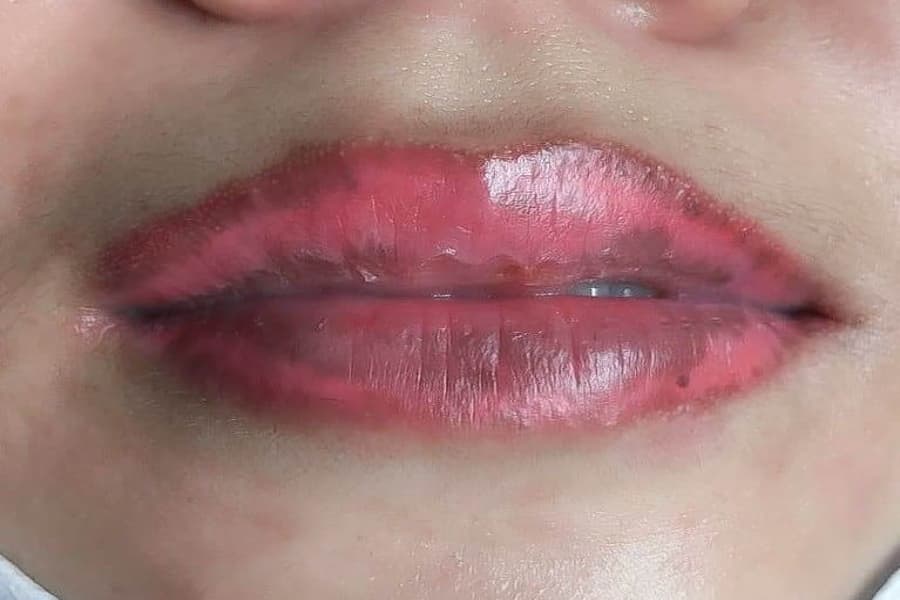 So sánh: massage, chườm ấm hay tiếp tục chườm lạnh — nên làm gì và khi nào để giảm sưng sau tiêm filler môi?