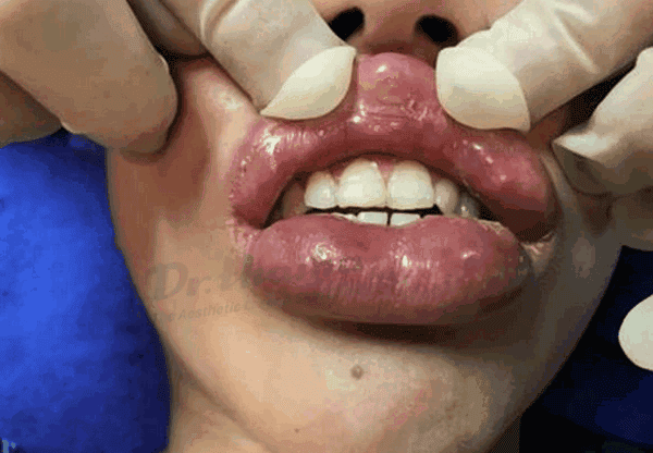 Những gì filler khác (non-HA) cần biết nếu đã tiêm trước đó?