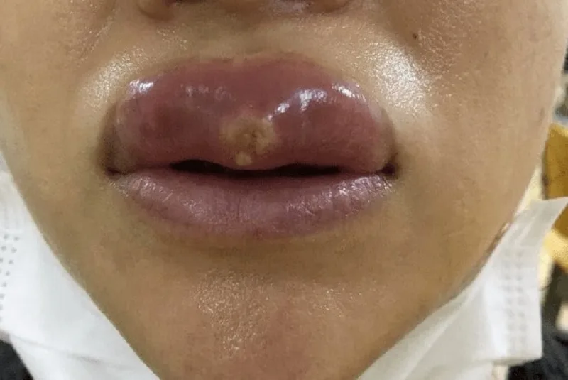 Phục hồi sau xử lý: kỳ vọng về thời gian, sẹo, và chăm sóc hậu thủ thuật