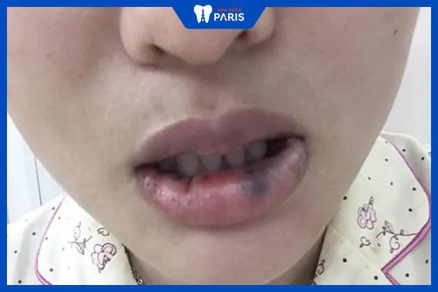 Tiêm môi filler có hại không — những biến chứng nào là thường gặp và nghiêm trọng?