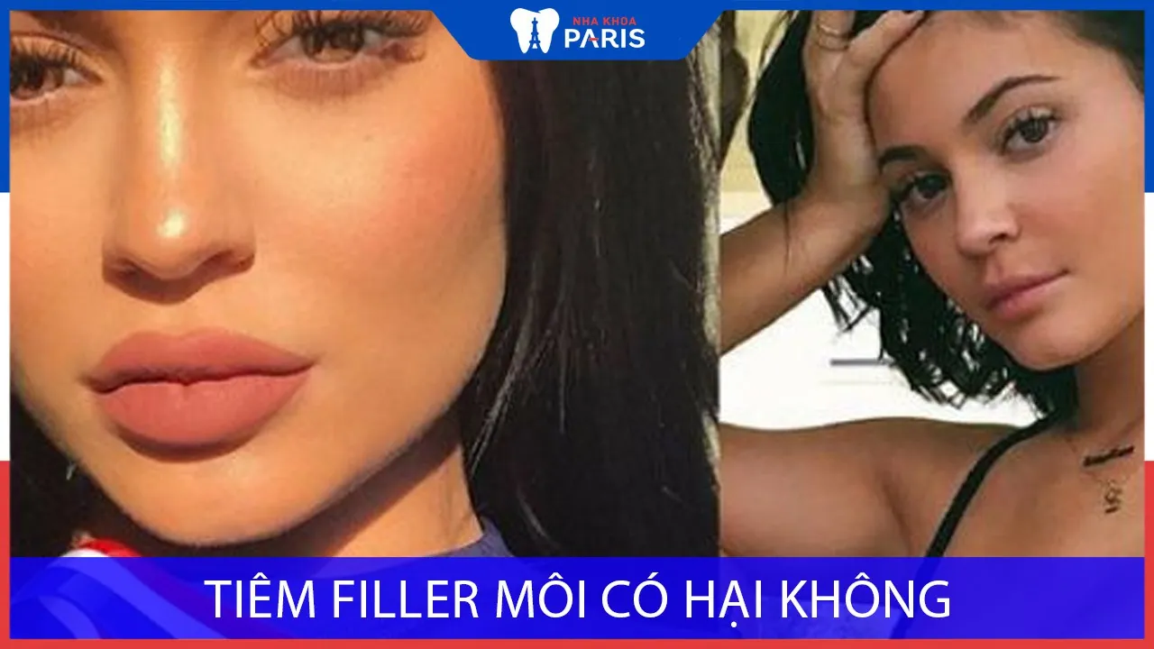 Gợi ý cuối cùng trước khi quyết định tiêm môi
