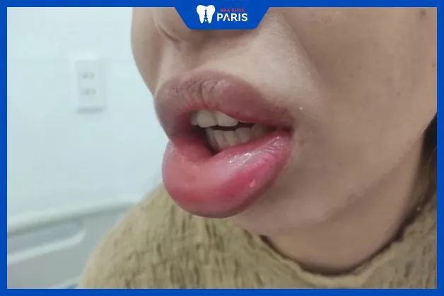 So sánh các phương pháp làm đầy môi: filler HA so với cấy mỡ tự thân và cấy ghép vĩnh viễn — sưng khác nhau thế nào?