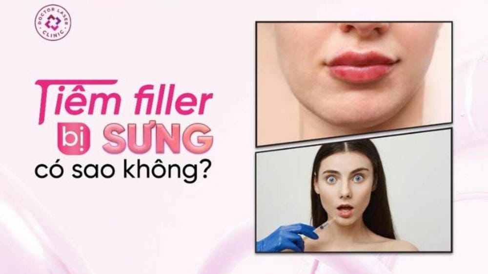 Tiêm filler có nên uống thuốc kháng viêm trước hoặc sau?