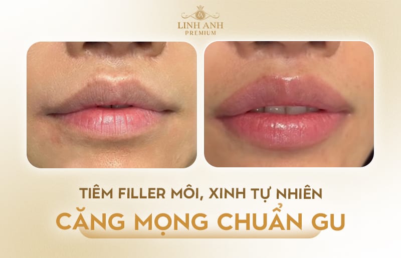 Tiêm môi bằng chất làm đầy nào bền nhất — so sánh các lựa chọn phổ biến?