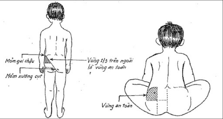 Chuyển mỡ tự thân (BBL)