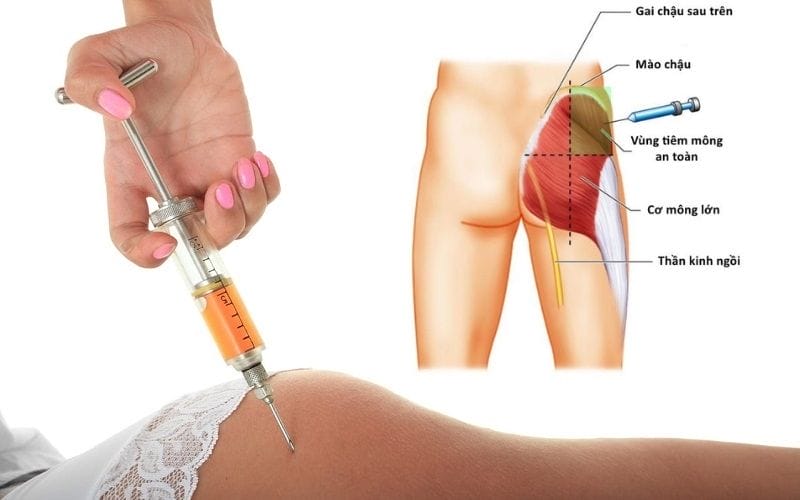 Chất kích thích tăng sinh collagen (ví dụ PLLA, PCL, PDLLA, CaHa)