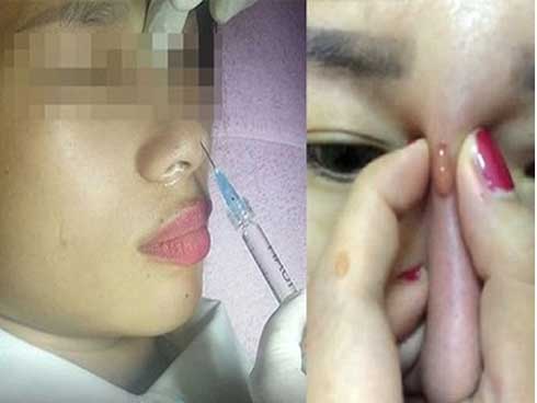 So sánh kỹ thuật: kim tiêm và cannula — loại nào an toàn hơn cho mũi?
