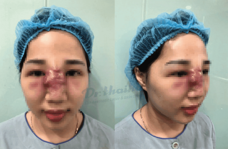 Tiêu chí chọn nơi tiêm mũi để giảm nguy cơ tràn và biến chứng