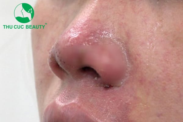 Làm sao để nhận biết ngay khi filler mũi bị tràn?