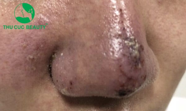 Nếu muốn hủy filler HA có thể làm ngay không?