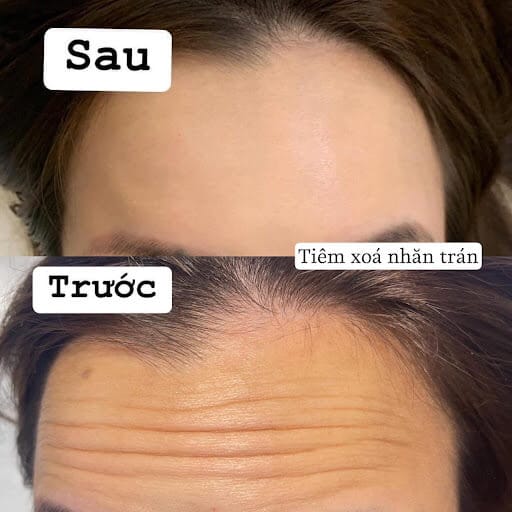 Microbotox (microdroplet) so với tiêm tiêu chuẩn: khác biệt và khi nào nên chọn?