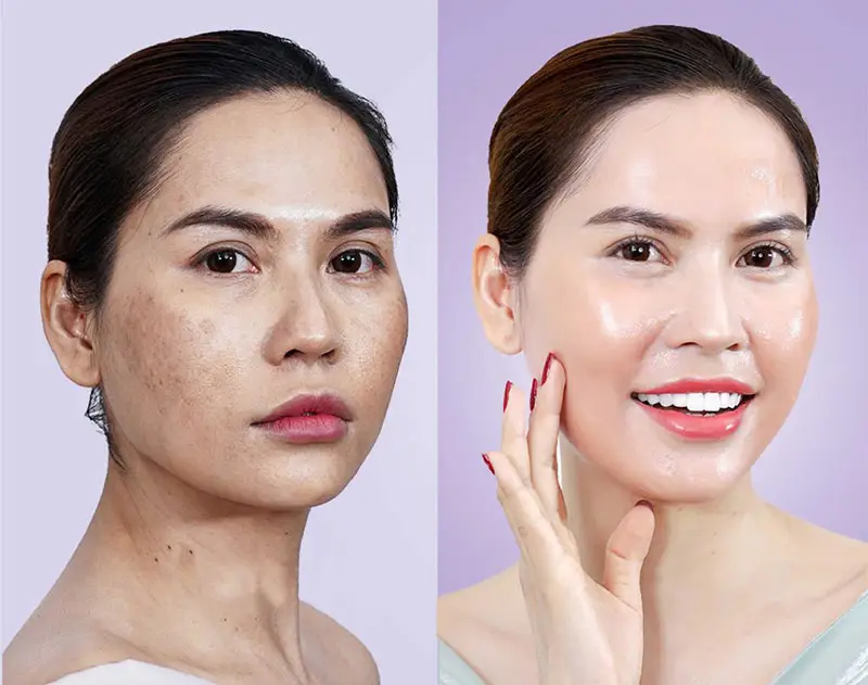 Cơ chế tác động của tiêm meso và TXA