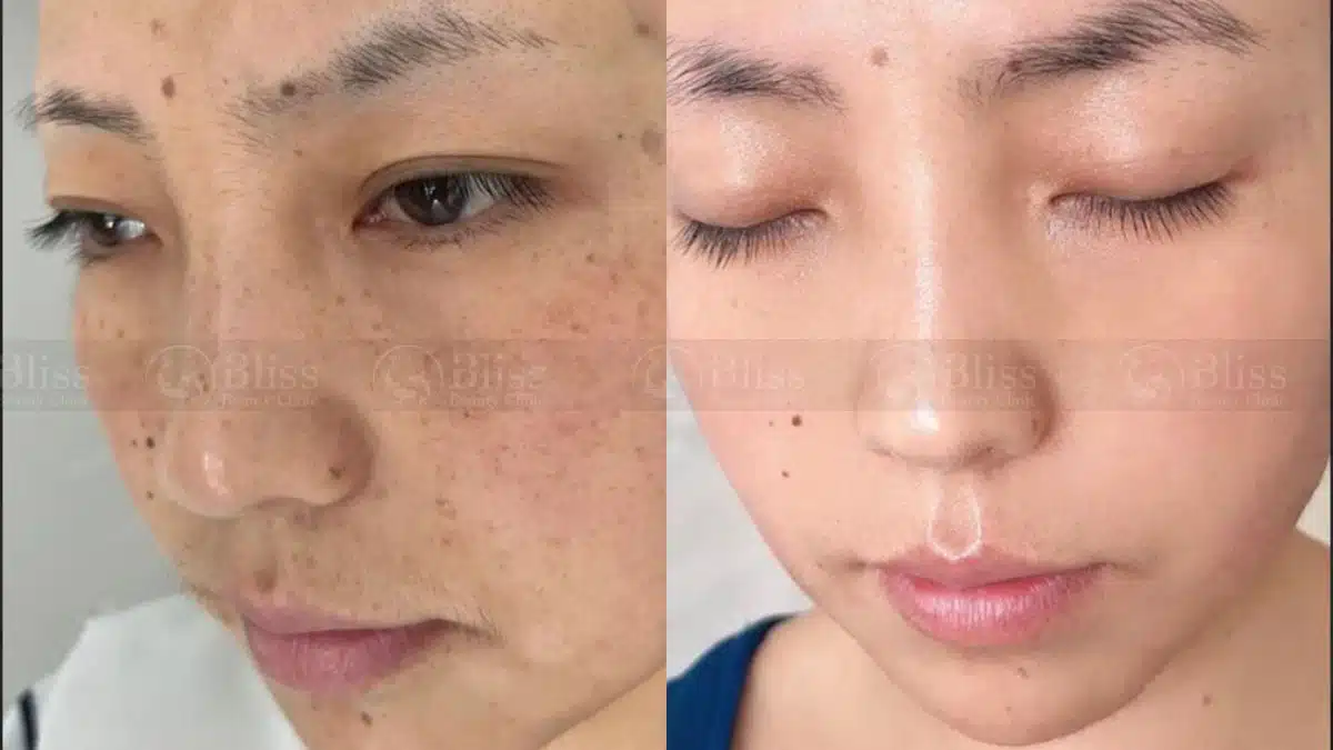 So sánh TXA, PRP trị nám, mesotherapy, microneedling — phương pháp nào tốt hơn?