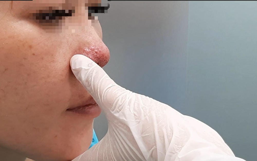 Chăm sóc sau tiêm và dấu hiệu cần tái khám ngay