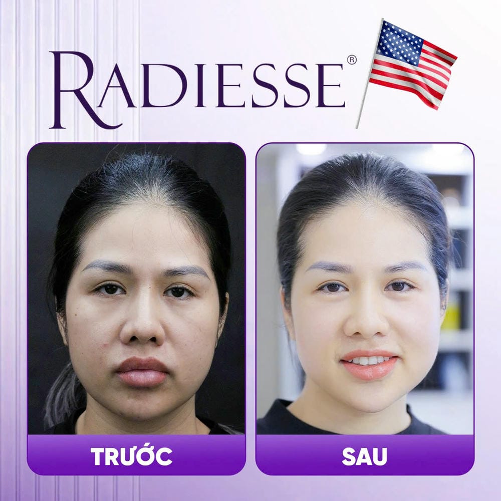 Kết quả ổn định kéo dài bao lâu? Thời gian duy trì Radiesse