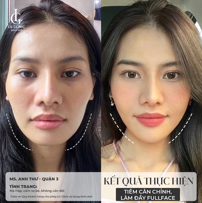 So sánh ngắn: Radiesse vs Sculptra vs Filler HA — chọn thế nào?