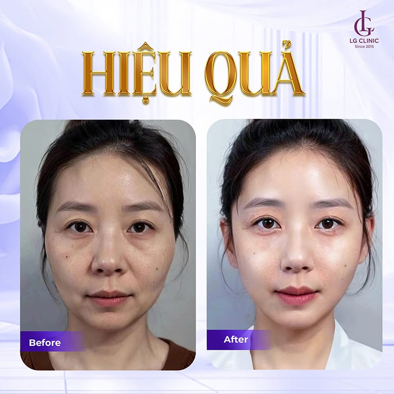 Làm gì ngay tại nhà khi phát hiện sưng sau tiêm Rejuran ở mắt?