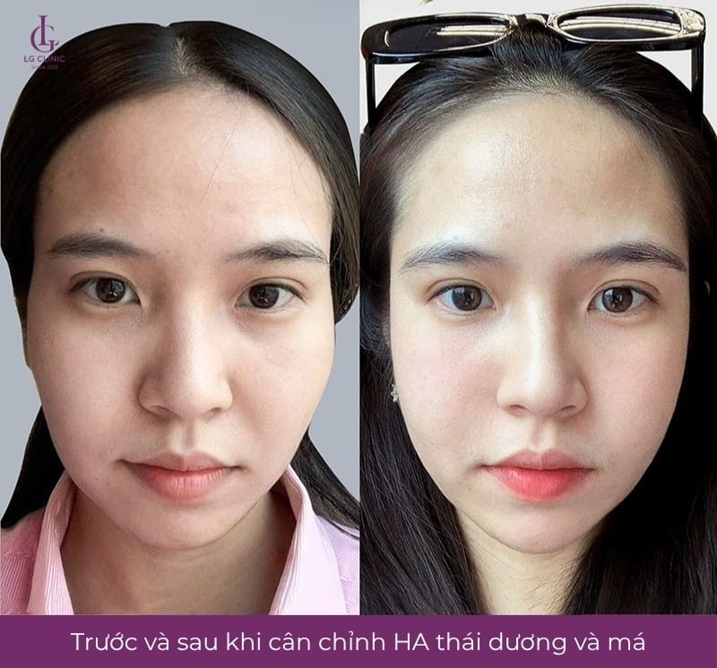 Ai phù hợp và ai nên tránh tiêm Restylane?