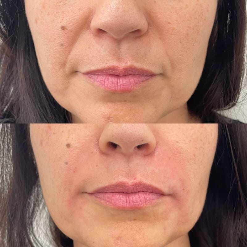 Tiêm rãnh cười nên chọn phương pháp nào — filler, botox hay kết hợp?