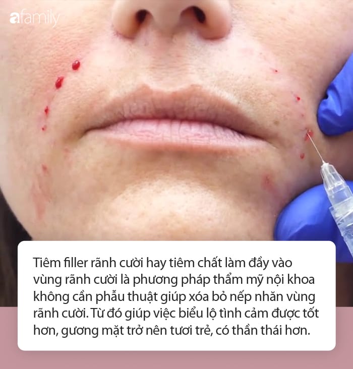Làm sao để chọn nơi tiêm rãnh cười uy tín và an toàn?
