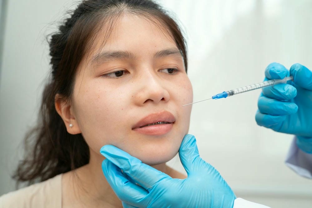 So sánh: Mỡ tự thân và filler HA rãnh cười — phương pháp nào phù hợp với ai?