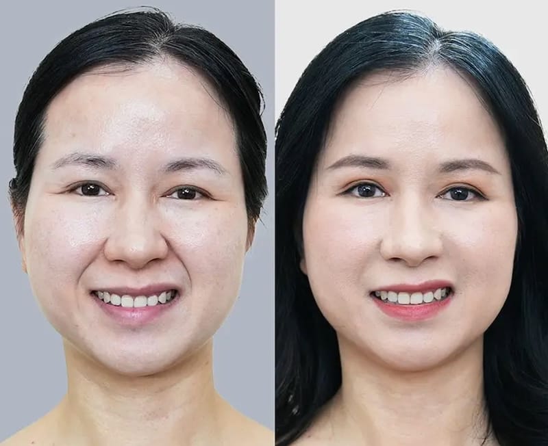 Quy trình tiêm rãnh cười an toàn — bác sĩ làm gì để tránh gây đơ?