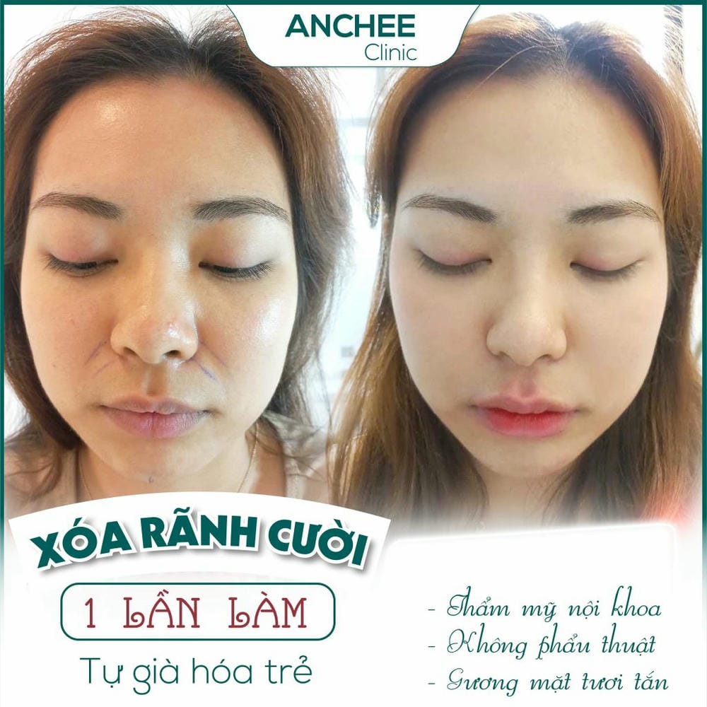 Làm sao để giảm tối đa nguy cơ trước khi quyết định tiêm?