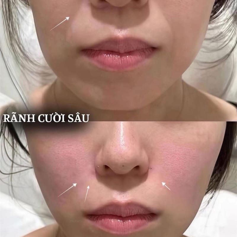 Làm sao chọn clinic và bác sĩ để tiêm rãnh cười an toàn?
