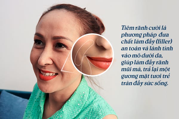 Hiệu quả kéo dài bao lâu và có cần tái tiêm định kỳ không?