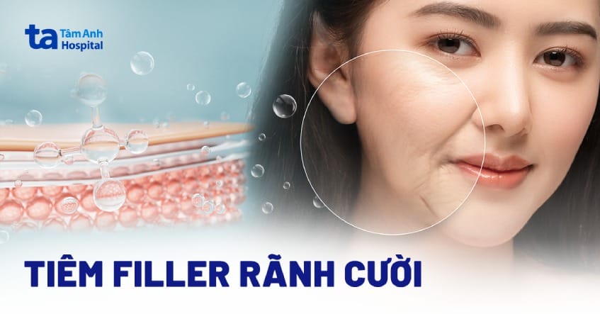 Làm thế nào để chọn nơi tiêm rãnh cười an toàn và có kết quả tự nhiên?