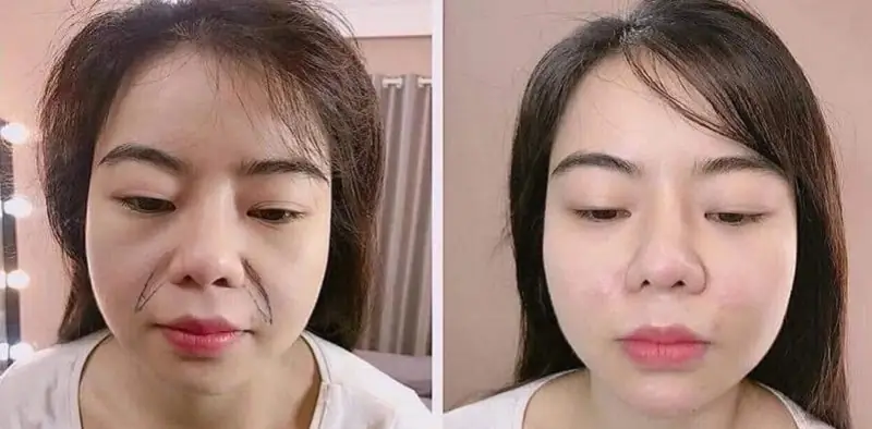 Cuối cùng, có lời khuyên nào trước khi quyết định tiêm rãnh cười?